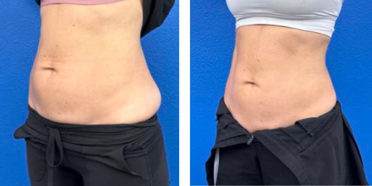Side view before and after one ONDA Coolwaves session on the abdomen: lower-belly fullness visibly reduced and waistline flatter after a single treatment