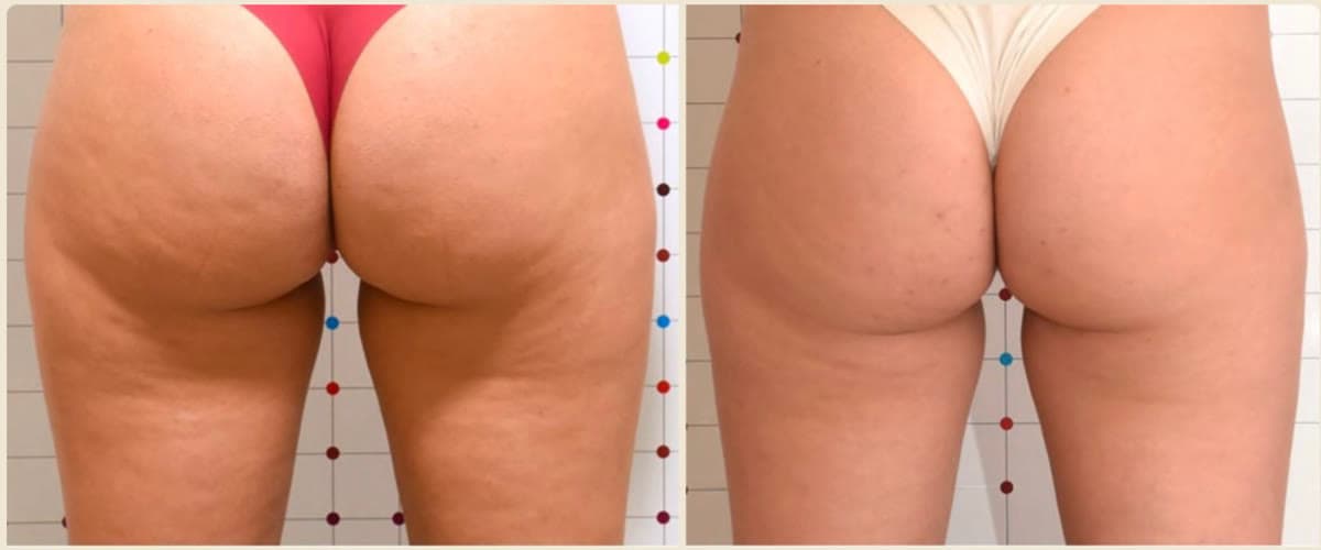 Before and after ONDA Coolwaves cellulite treatment on the buttocks and thighs at Neoderma Anaheim: dimpling visibly smoothed