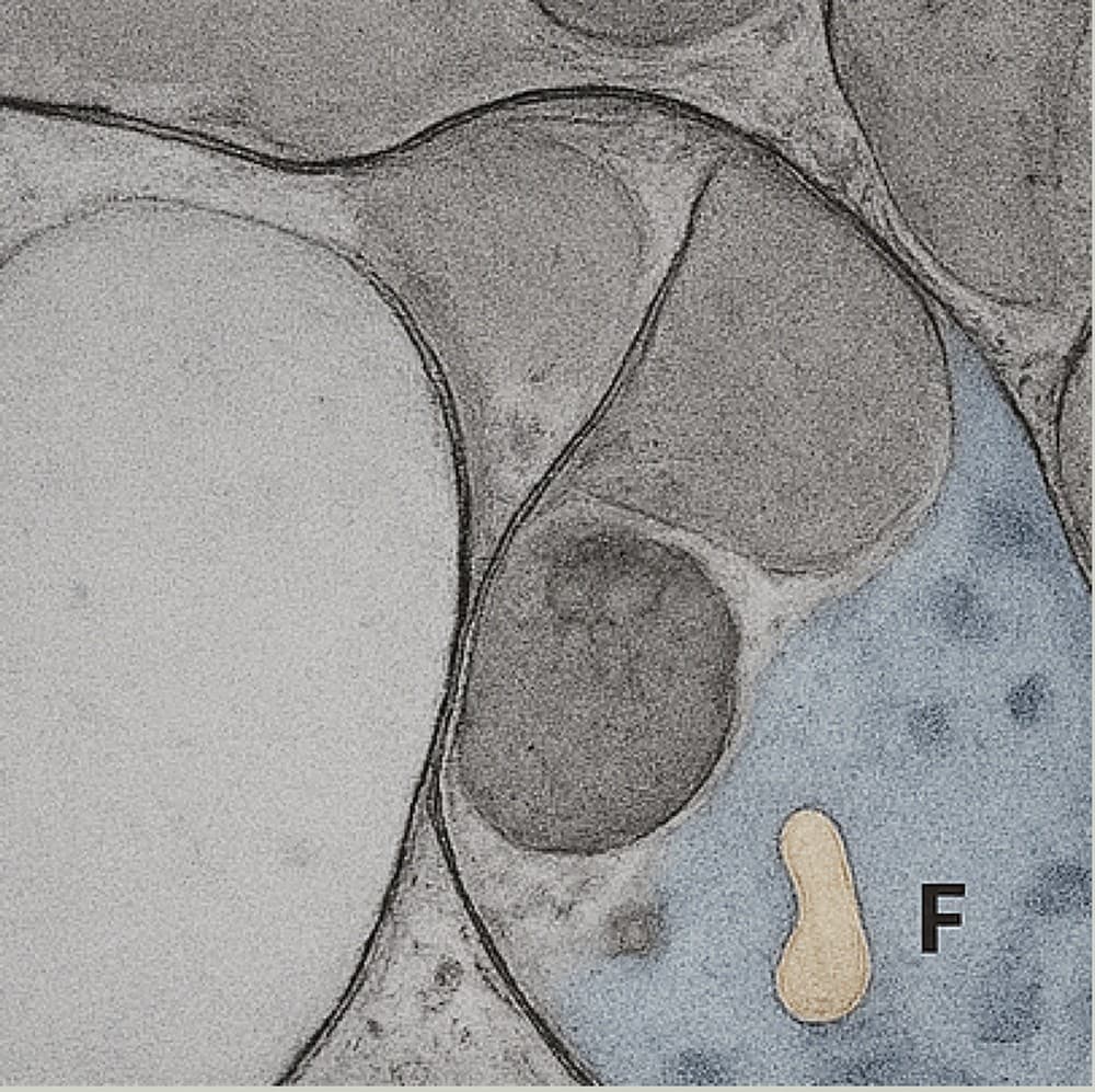 Electron micrograph after ONDA treatment — an adipocyte membrane disrupted by microwave-induced heating, with released lipid visible