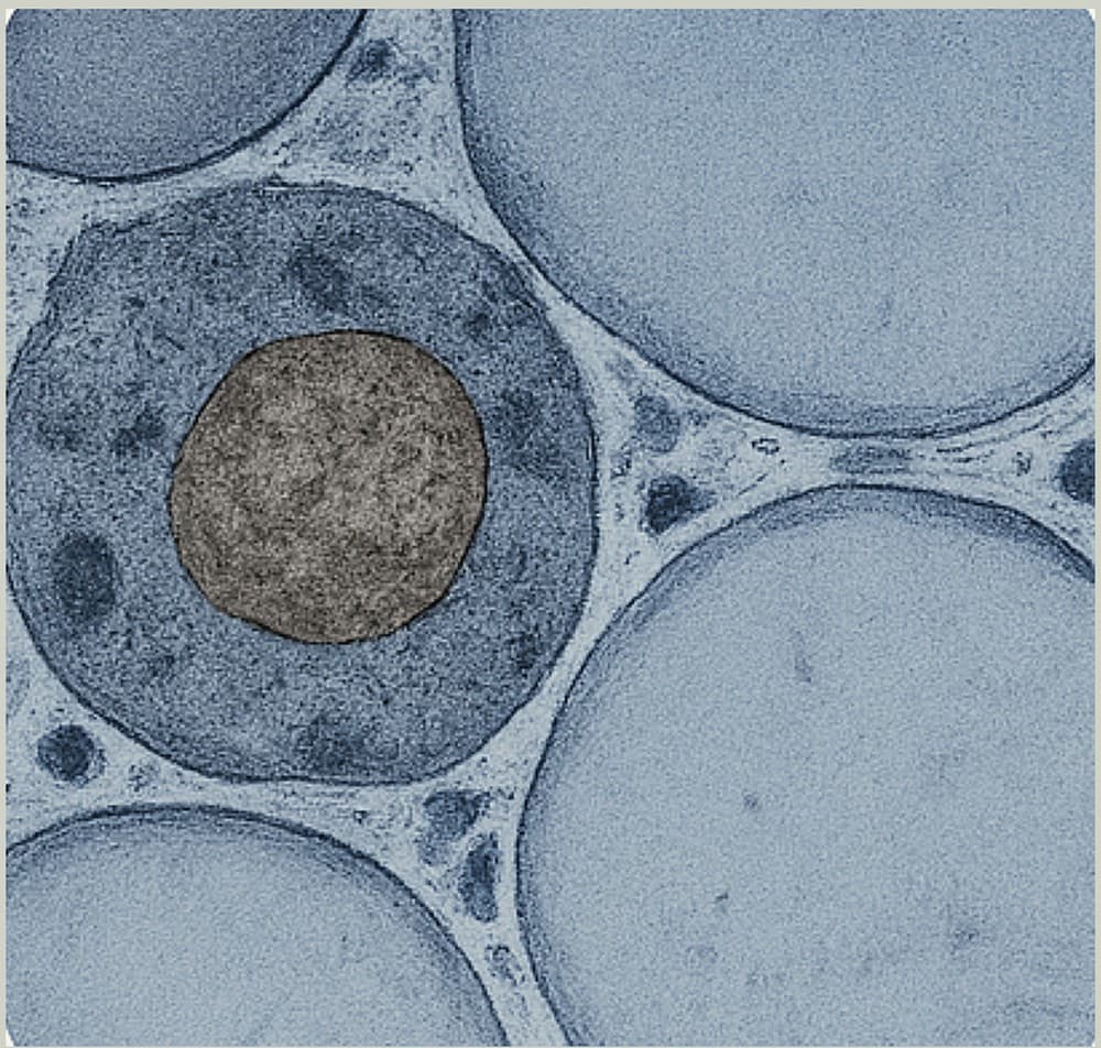 Histology showing monocyte and macrophage activity — an immune cell surrounded by adipocytes, clearing cellular debris after treatment