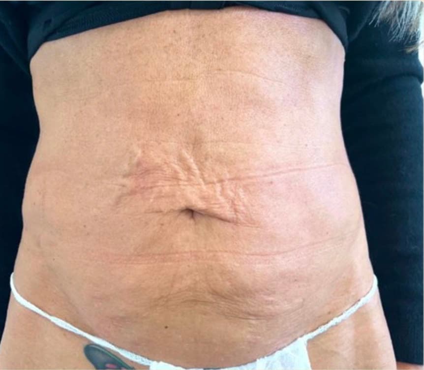 Smoother, contoured body after ONDA at Neoderma Anaheim