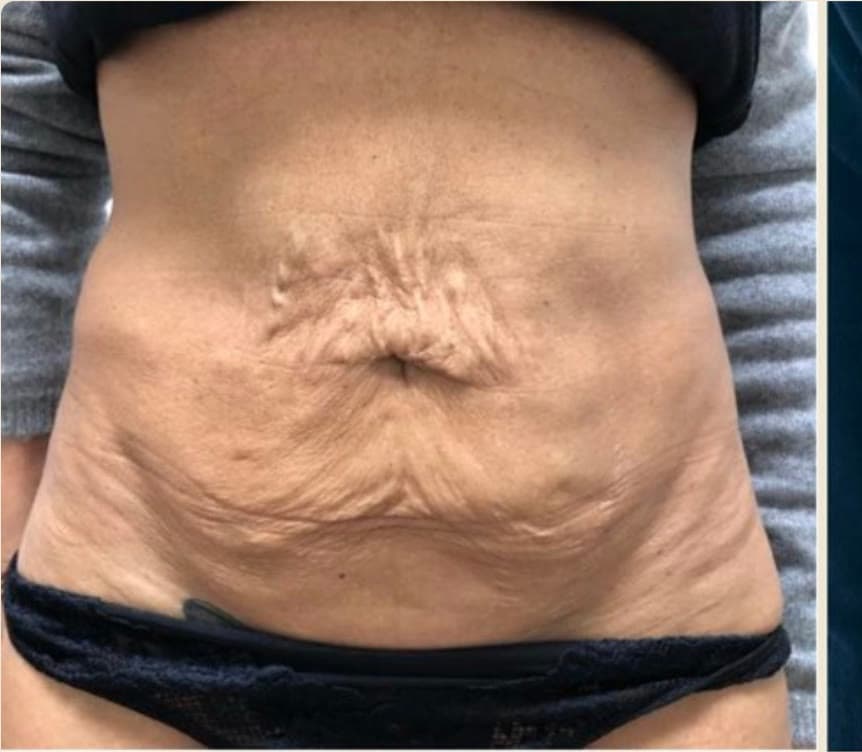 Before ONDA Coolwaves body contouring at Neoderma Anaheim: abdomen with loose, uneven skin