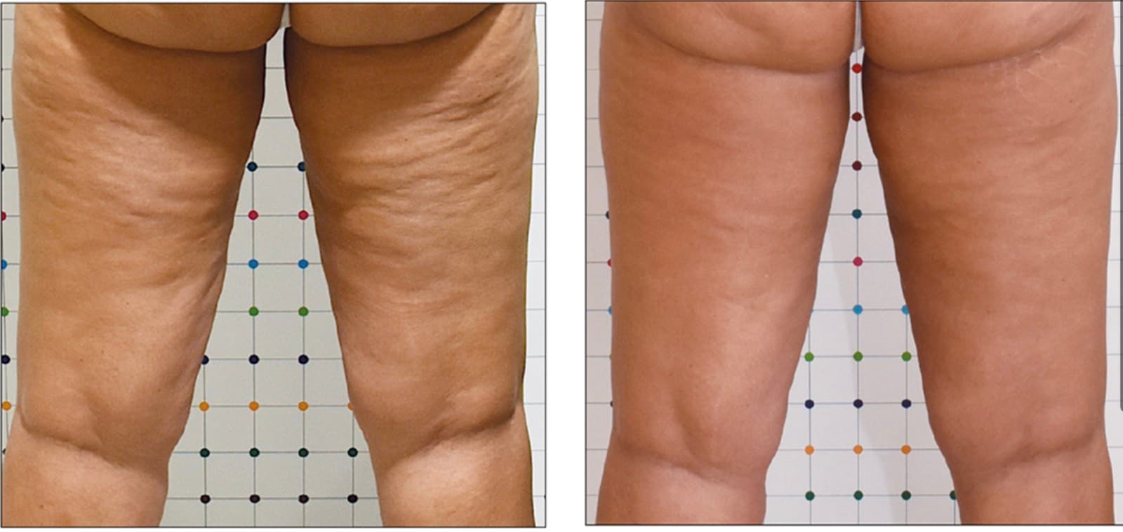 Before and after ONDA Coolwaves cellulite treatment on the back of the thighs: dimpling visibly smoothed and skin firmer