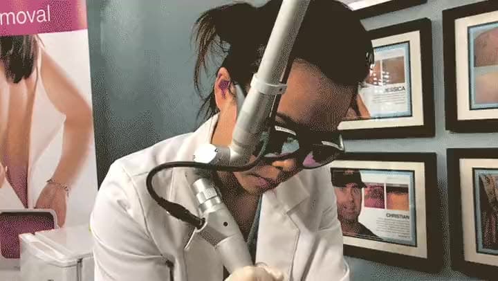 PicoWay Resolve laser treating pigment at Neoderma Anaheim