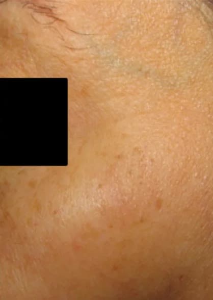 After PicoWay Resolve at Neoderma Anaheim: the sun spot faded and skin tone evened out