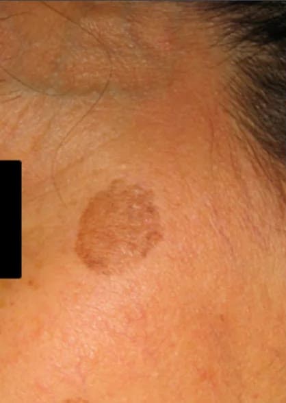 Before PicoWay Resolve at Neoderma Anaheim: a dark sun spot on the temple and uneven pigmentation