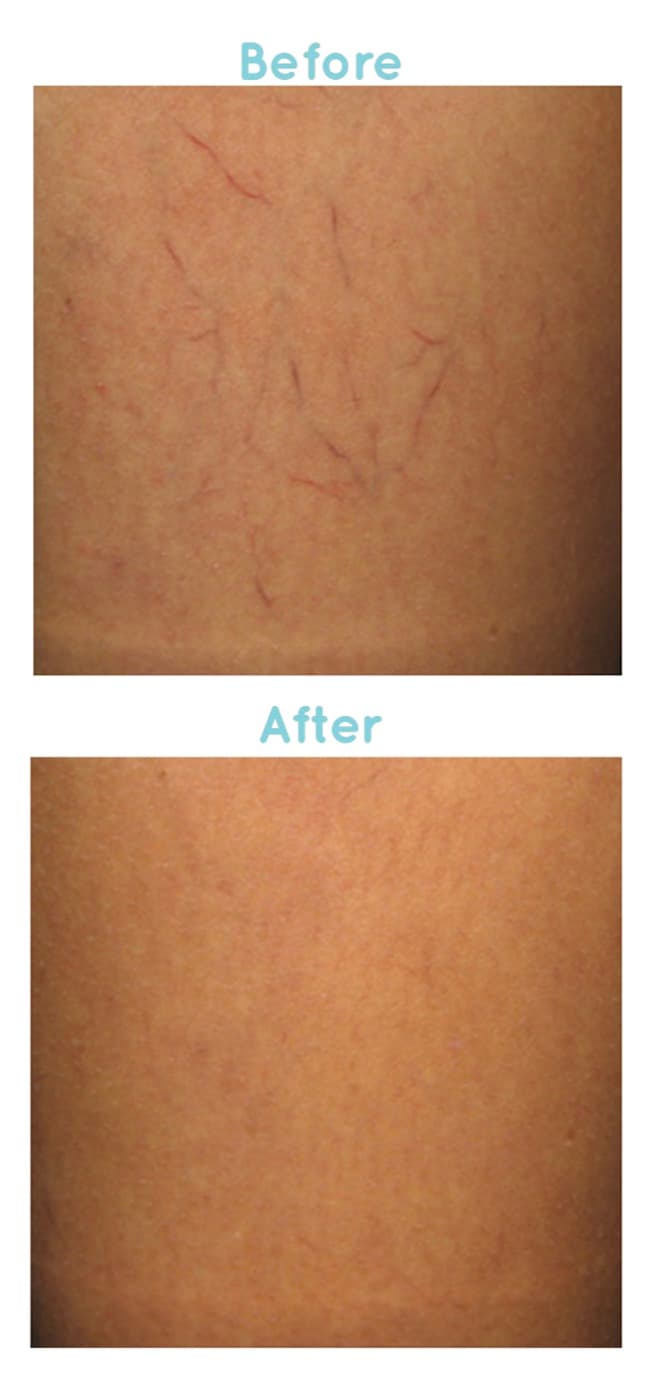 Before and after sclerotherapy for leg spider veins at Neoderma Anaheim — visibly clearer skin