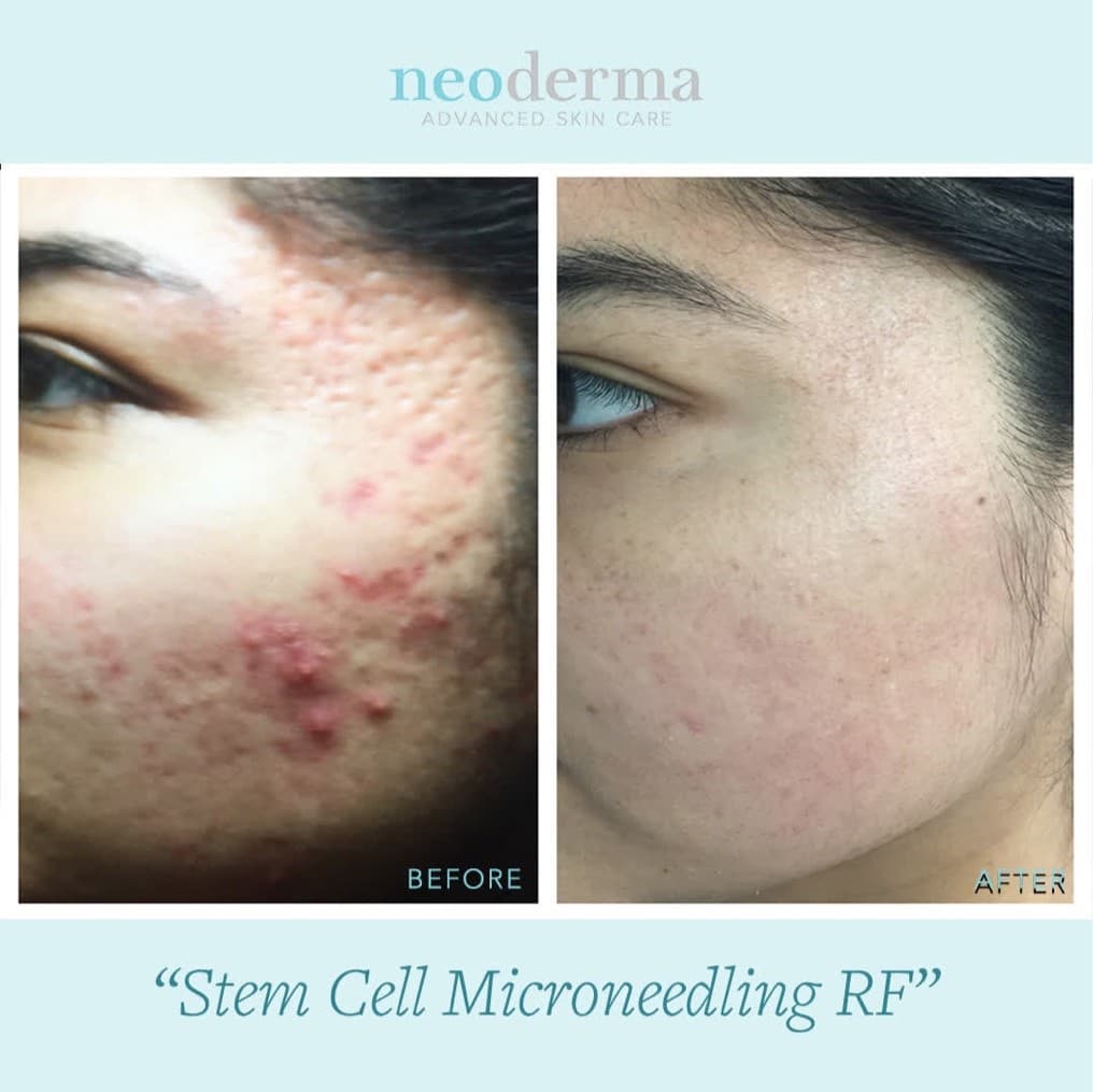 Before and after Secret RF microneedling at Neoderma Anaheim: deep acne scarring, texture, and active breakouts on the cheek visibly smoothed and refined