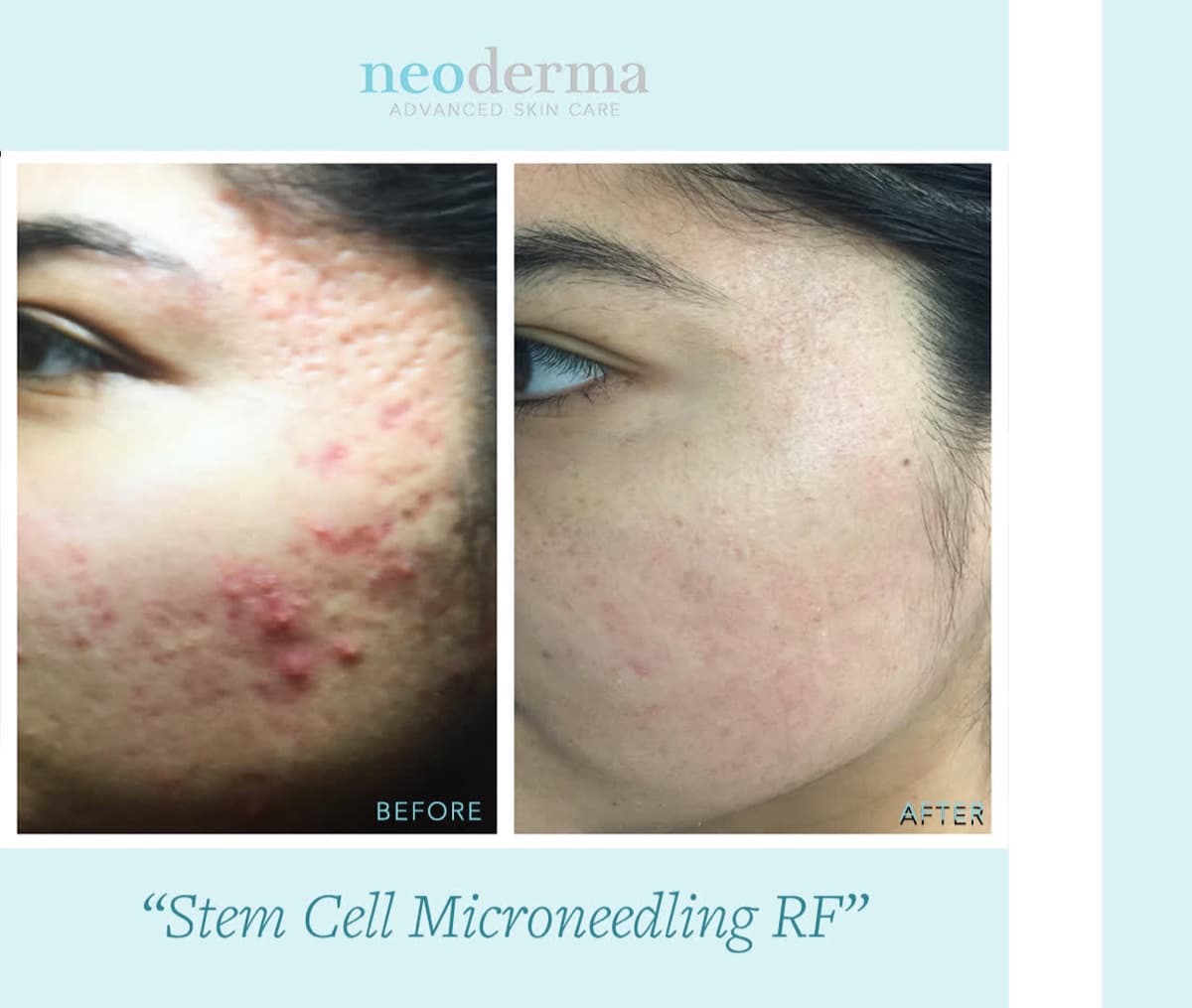 Before and after Secret RF microneedling at Neoderma Anaheim: deep acne scarring, texture, and active breakouts on the cheek visibly smoothed and refined