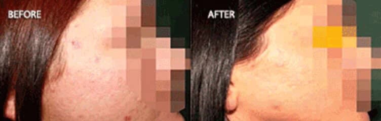 Before and after Secret RF microneedling at Neoderma Anaheim: acne scarring on the cheek smoothed