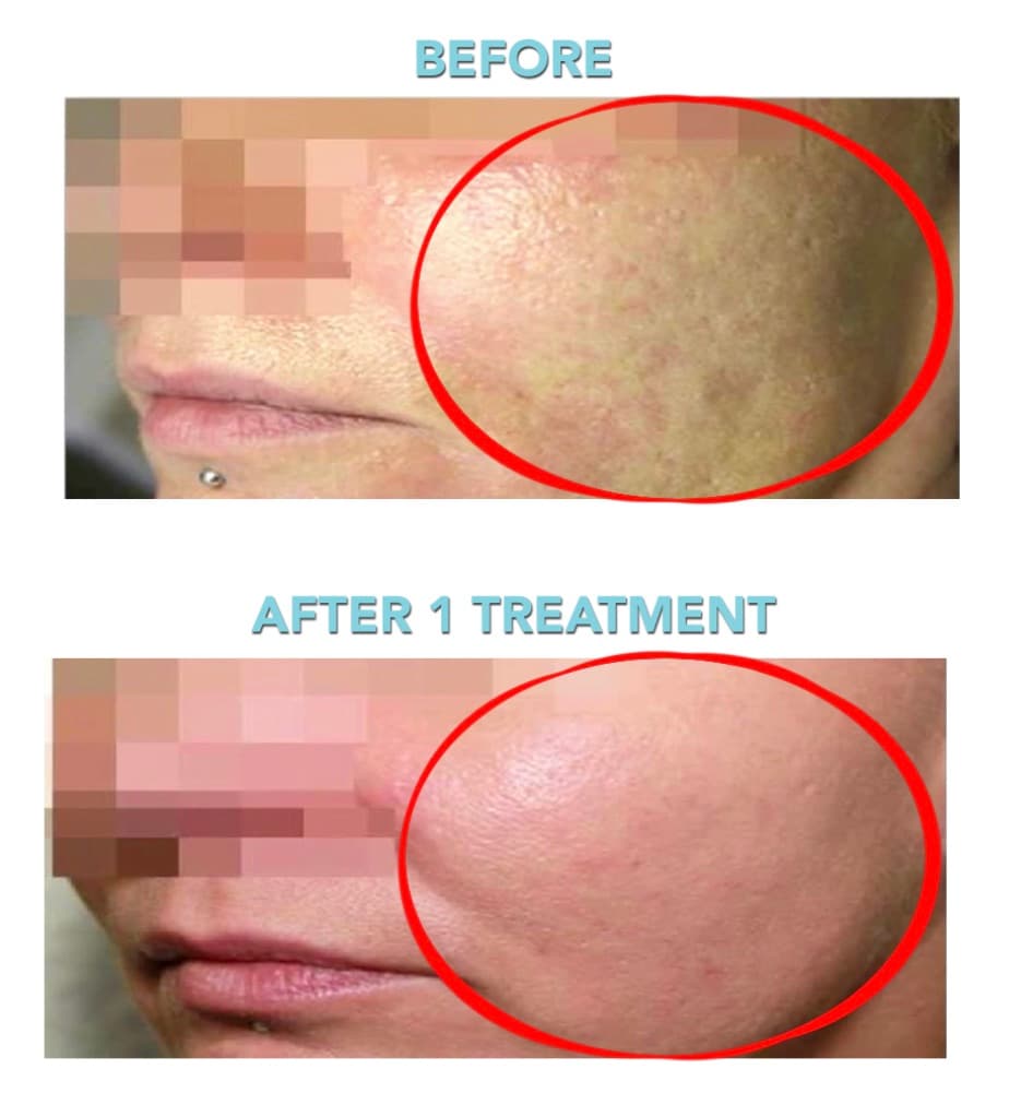 Before and after Secret RF microneedling at Neoderma Anaheim: enlarged pores and rough texture on the cheek visibly refined after one treatment