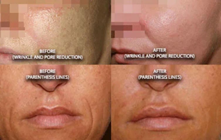 Before and after Secret RF microneedling at Neoderma Anaheim: enlarged pores and parenthesis lines visibly reduced