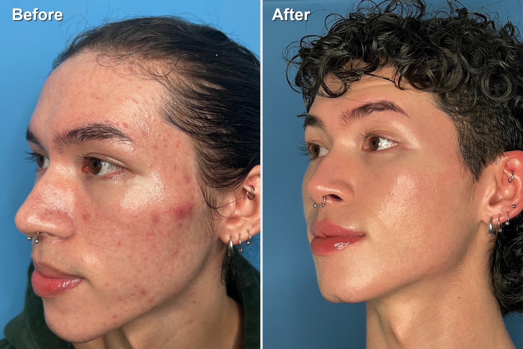 Before and after at Neoderma Anaheim: active, inflamed acne on the cheeks and forehead cleared to calm, even skin with a DiamondGlow and medical-grade skin care plan (side profile)