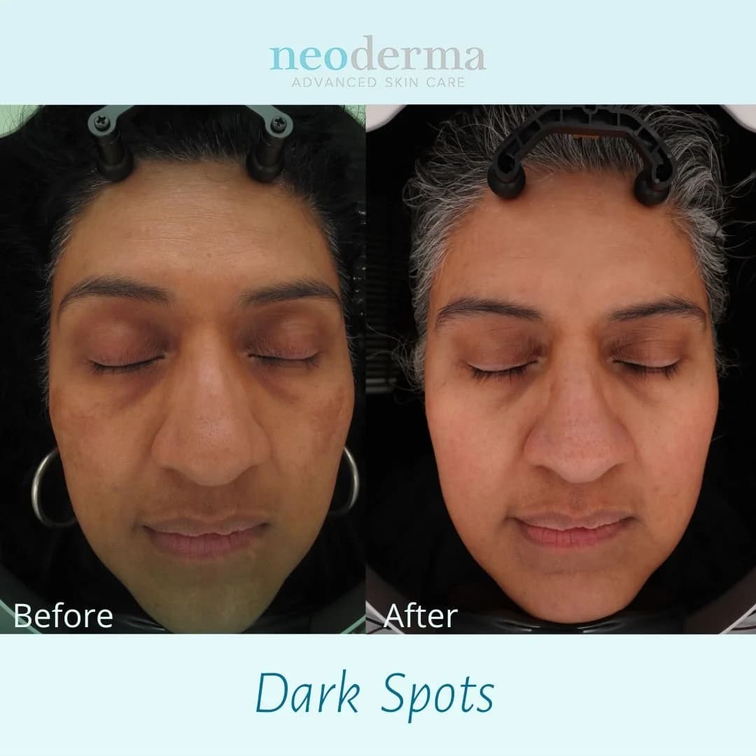 Dark spots faded on a client at Neoderma Anaheim after a peel series paired with a medical-grade home skin care regimen