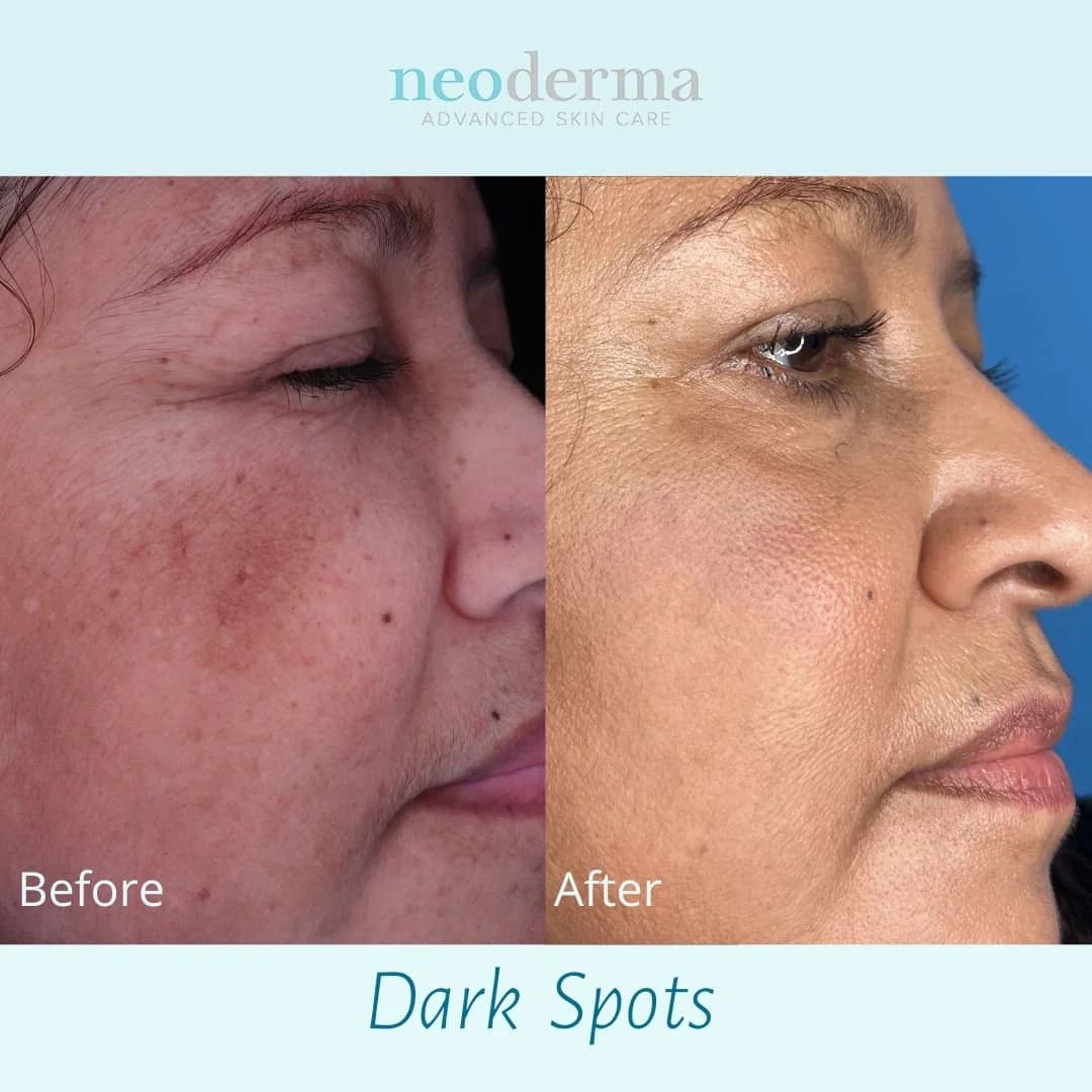 Before and after a customized Neoderma skin care regimen: sun spots and pigmentation on the cheek visibly reduced