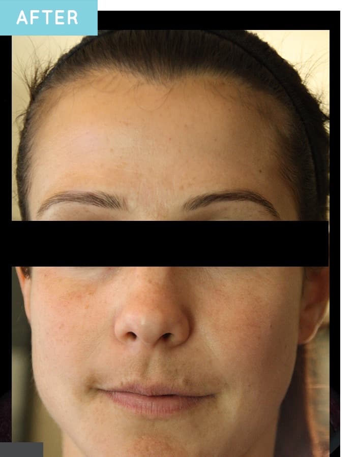 After a customized Neoderma medical-grade skin care plan: clear, even skin tone with the melasma faded