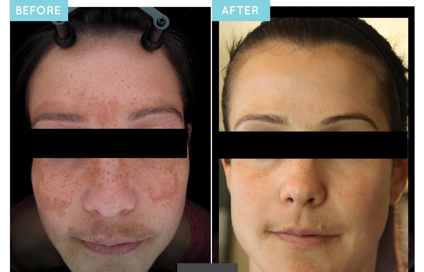 Before and after a customized Neoderma medical-grade treatment-and-home-care plan in Anaheim: heavy melasma across the forehead, cheeks and upper lip faded to an even skin tone