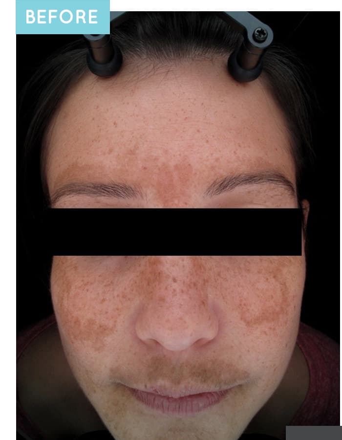 Before a customized Neoderma medical-grade skin care plan: heavy melasma and pigmentation across the face