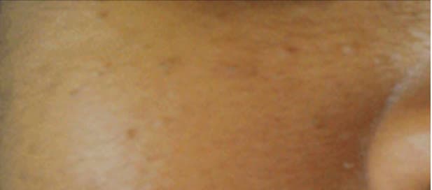 Smooth, clear skin after skin tag removal at Neoderma Anaheim