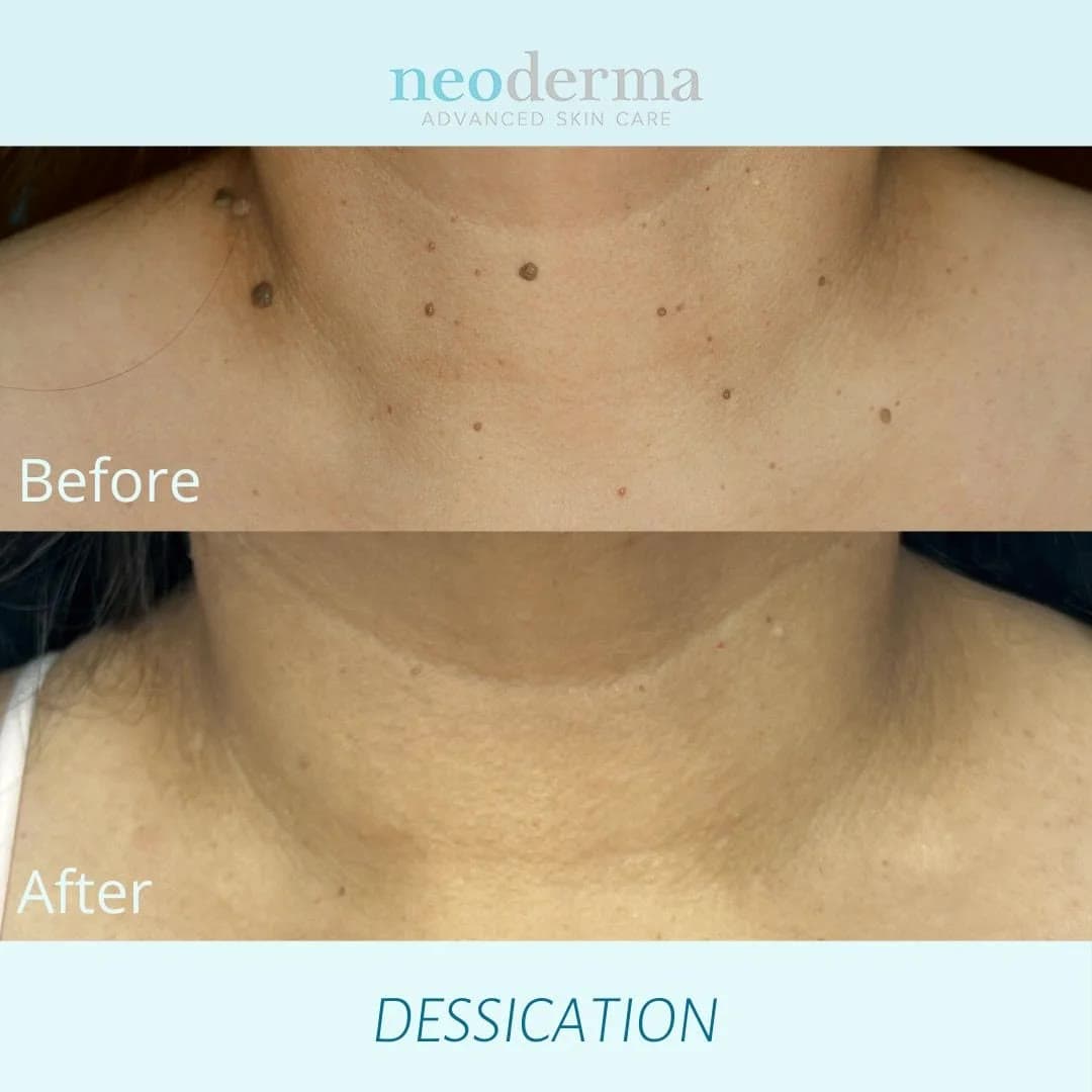 Before and after desiccation at Neoderma Anaheim: raised growths across the neck and chest removed for smooth skin
