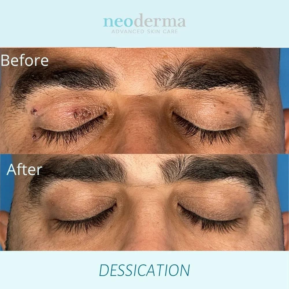 Small skin tags along the upper eyelids before treatment and the same lids clear afterward at Neoderma in Anaheim