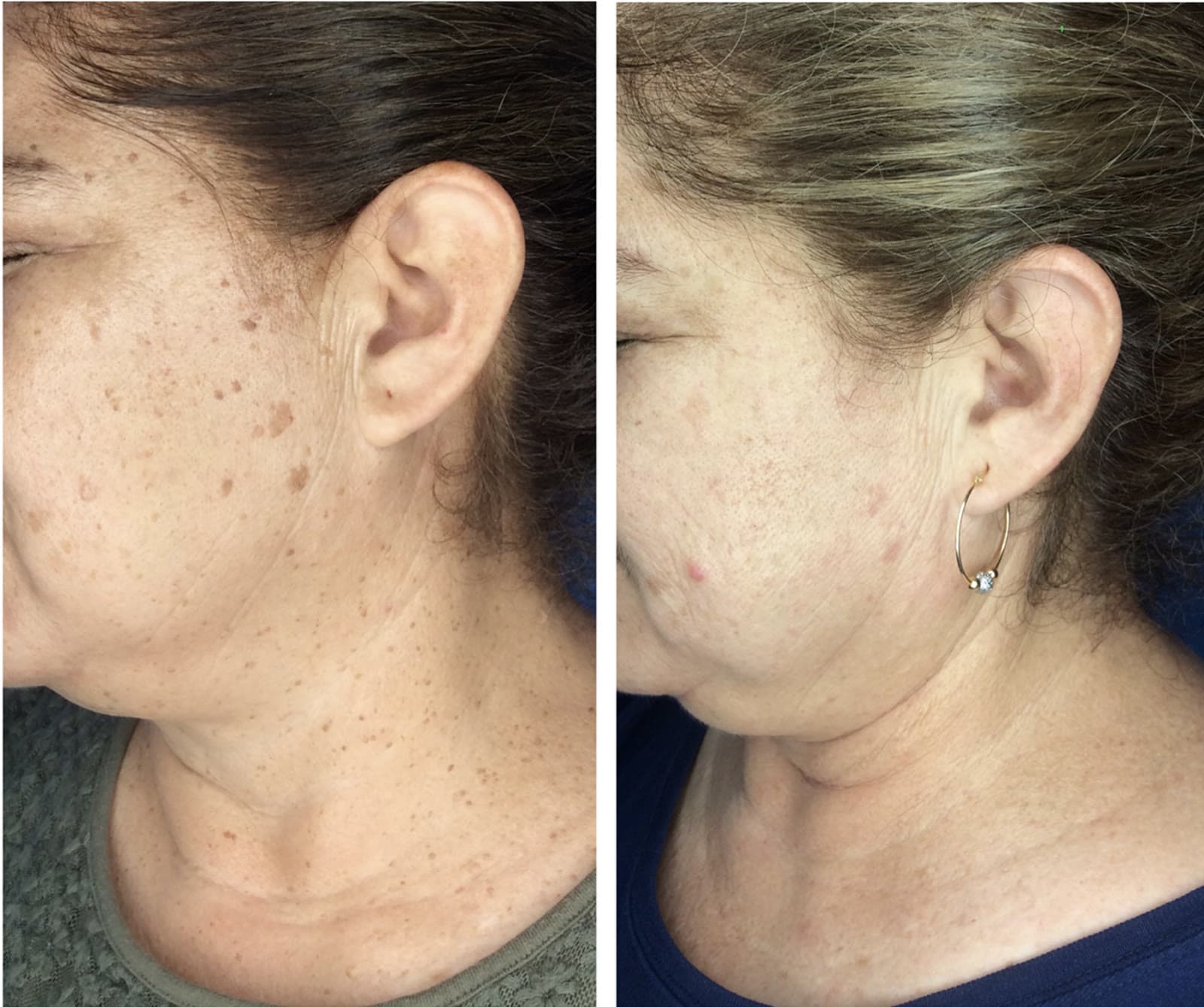 A face and neck dotted with many raised growths before treatment, then smooth and clear after desiccation at Neoderma in Anaheim