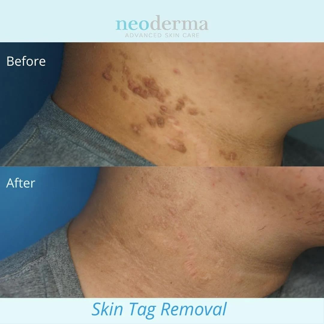 Before and after skin tag removal at Neoderma Anaheim: a cluster of larger raised growths on the neck dramatically reduced