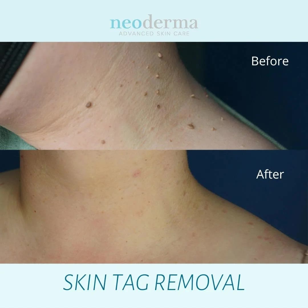 Before and after skin tag removal on the neck at Neoderma Anaheim — every tag cleared with smooth skin