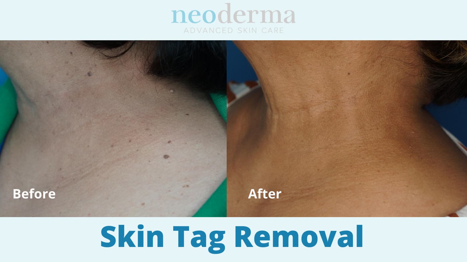 Before and after skin tag removal at Neoderma Anaheim: multiple raised skin tags across the neck and shoulder removed