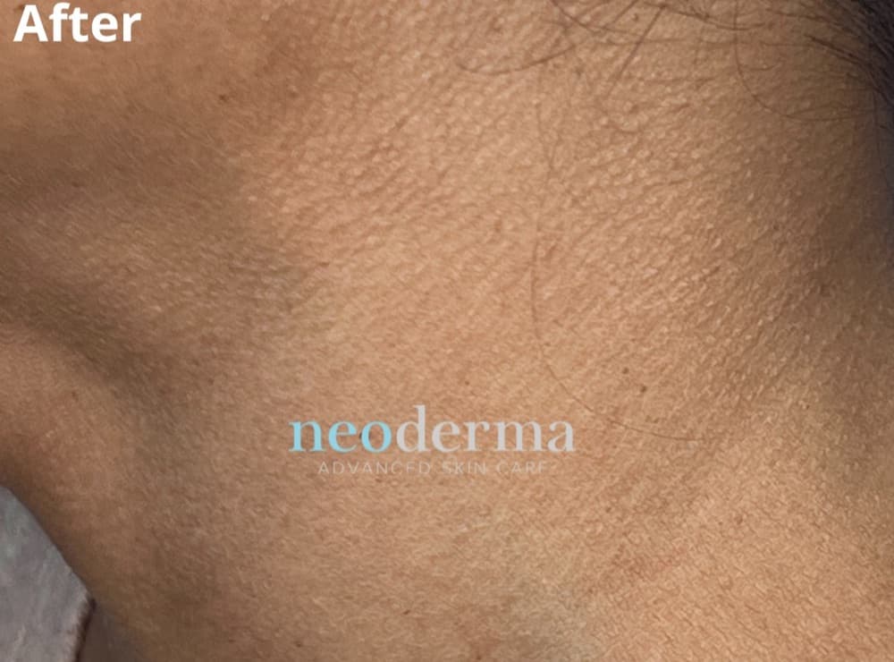 After skin tag removal at Neoderma Anaheim: the same neck smooth and clear with even skin tone