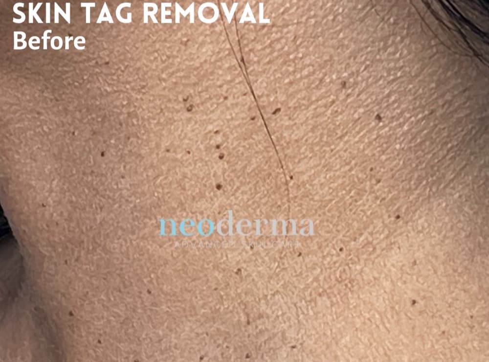 Before skin tag removal at Neoderma Anaheim: neck and décolleté covered with dozens of small skin tags