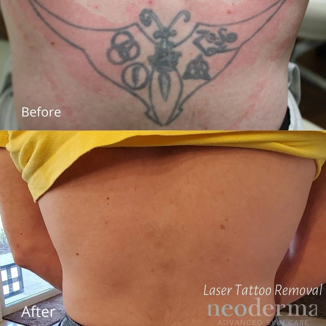 Before and after laser tattoo removal at Neoderma Anaheim: upper-back butterfly tattoo fully removed