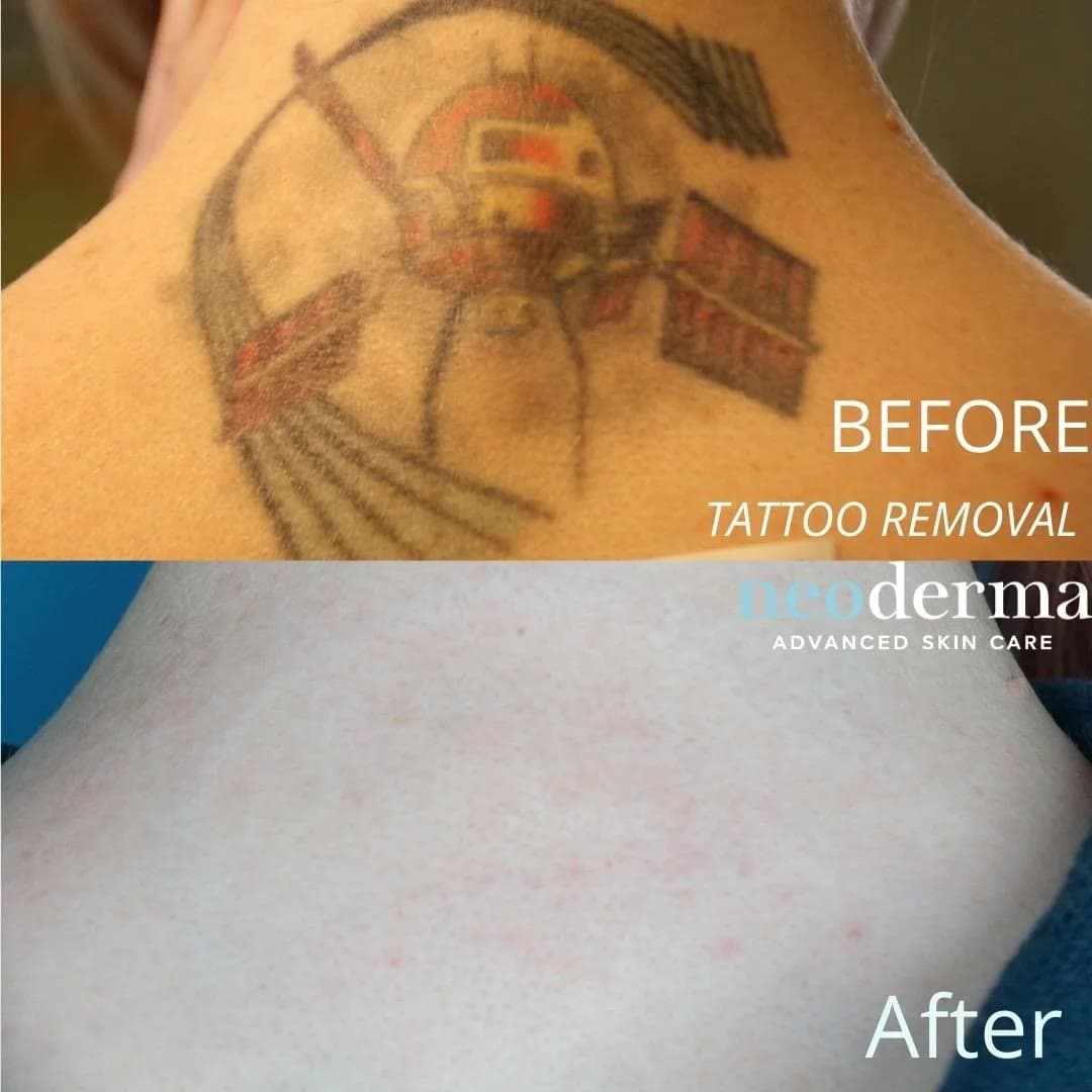 Before and after laser tattoo removal at Neoderma Anaheim: multi-colored back tattoo fully cleared