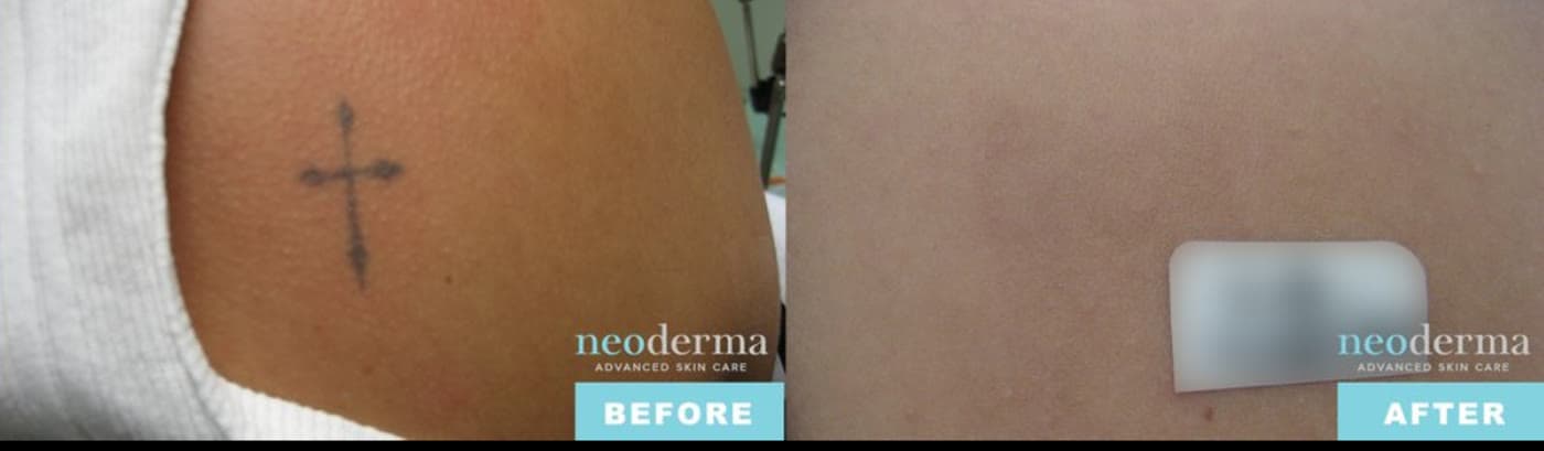 Before and after laser tattoo removal at Neoderma Anaheim: small cross tattoo fully cleared