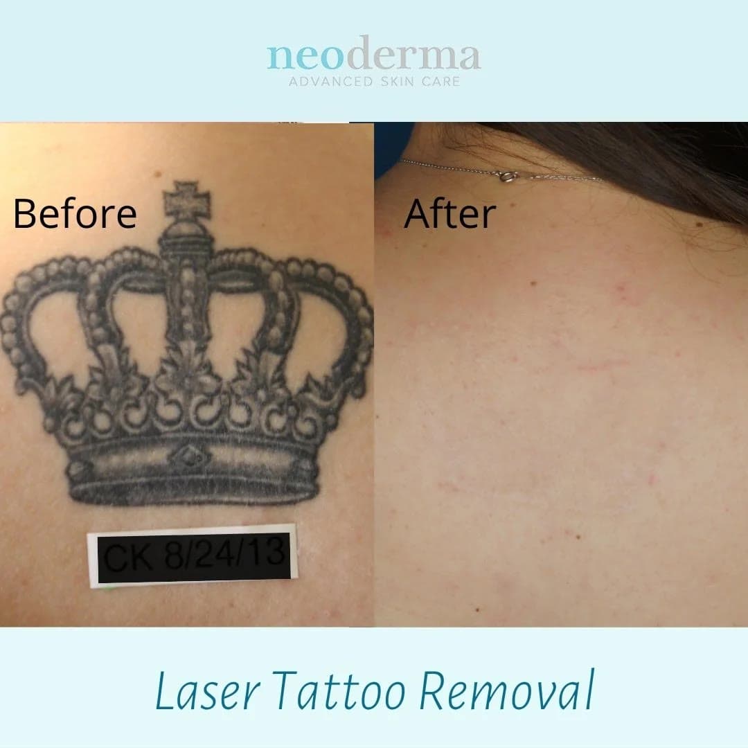 Before and after laser tattoo removal at Neoderma Anaheim: black crown tattoo with a name fully removed