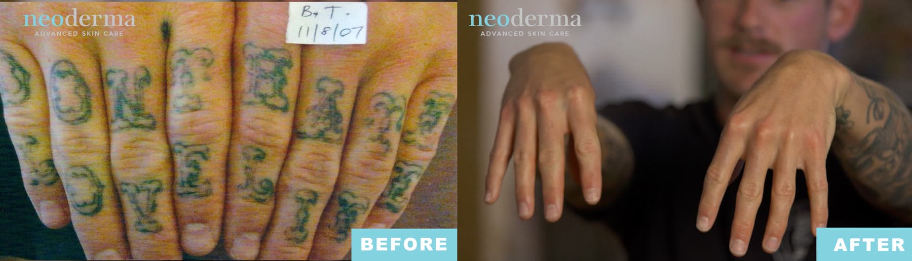 Before and after laser tattoo removal at Neoderma Anaheim: green “ONE LOVE” lettering across the fingers, fully cleared
