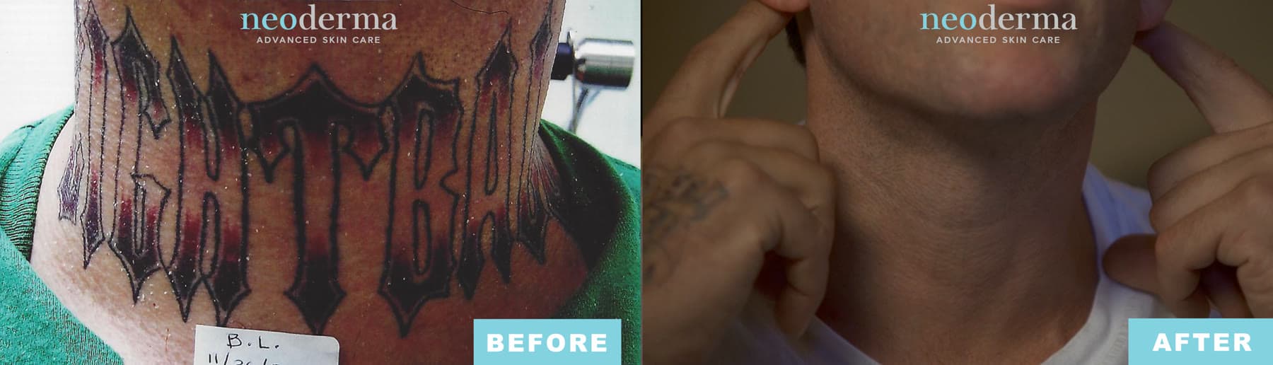 Before and after laser tattoo removal at Neoderma Anaheim: large gothic neck lettering fully cleared