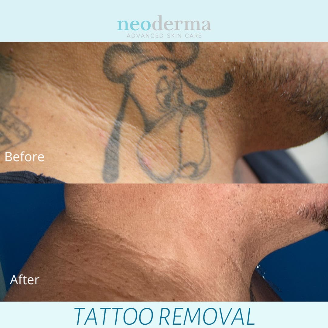 Before and after laser tattoo removal at Neoderma Anaheim: neck and jawline tattoo fully removed with PicoWay