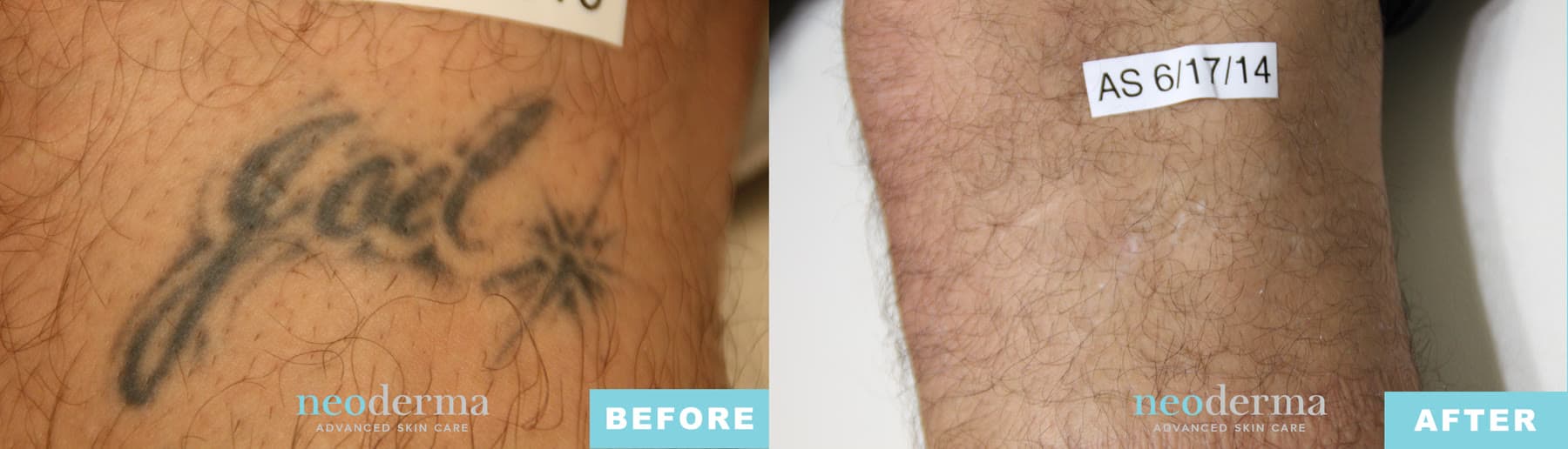 Before and after laser tattoo removal at Neoderma Anaheim: black script tattoo with a starburst fully cleared