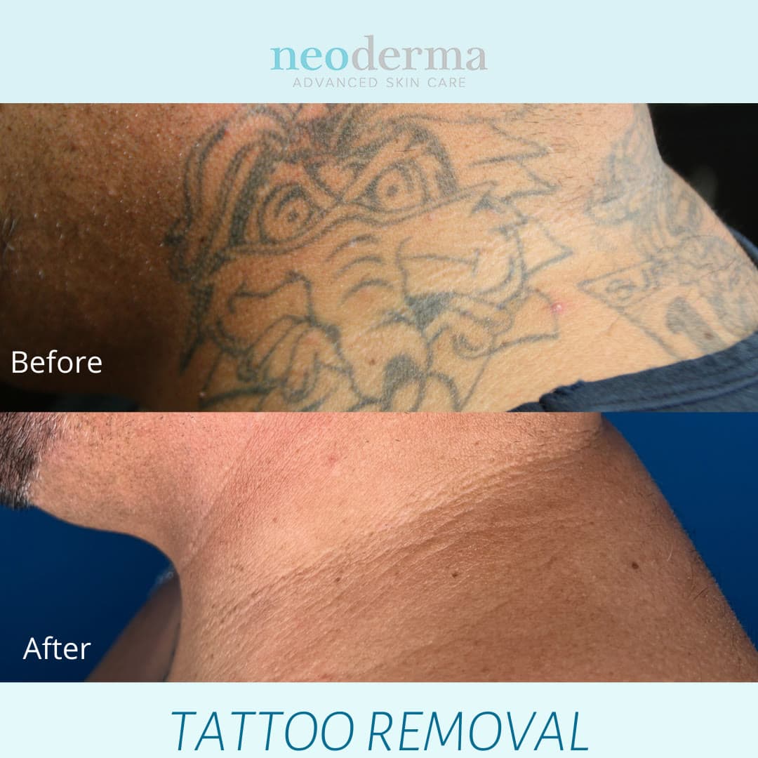 Before and after laser tattoo removal at Neoderma Anaheim: large shoulder and upper-arm tattoo fully cleared with PicoWay