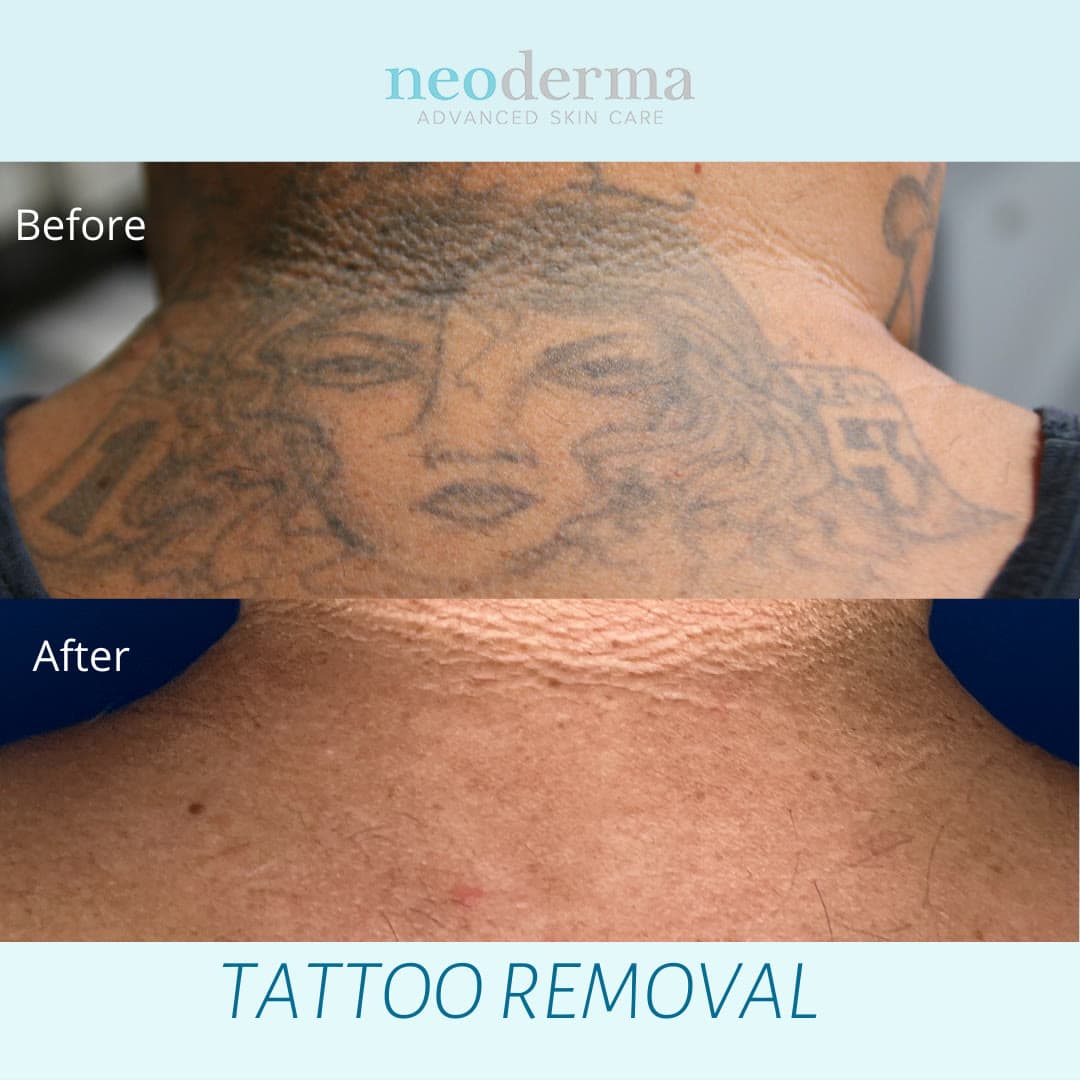 Before and after laser tattoo removal at Neoderma Anaheim: a large upper-back portrait tattoo fully removed with PicoWay