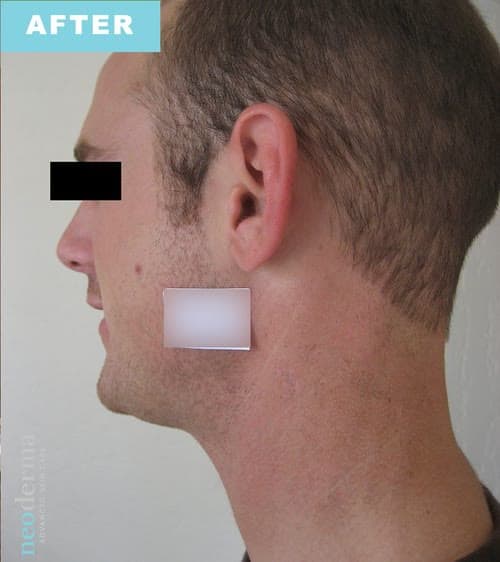 After laser tattoo removal at Neoderma Anaheim: the same neck fully cleared with healthy skin and no visible ink