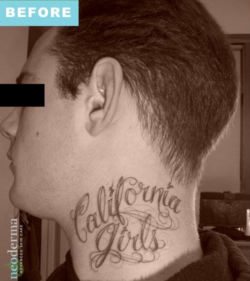 Before laser tattoo removal at Neoderma Anaheim: a California Girls script tattoo across the side of the neck