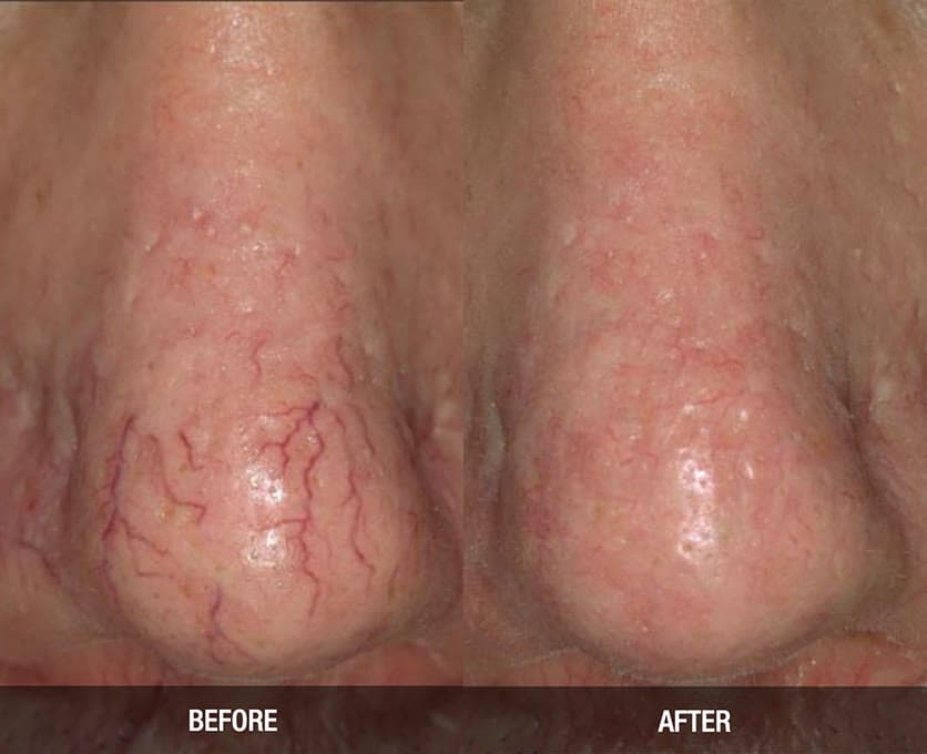 Before and after laser vein treatment around the nose at Neoderma Anaheim: broken red capillaries beside the nostril visibly cleared