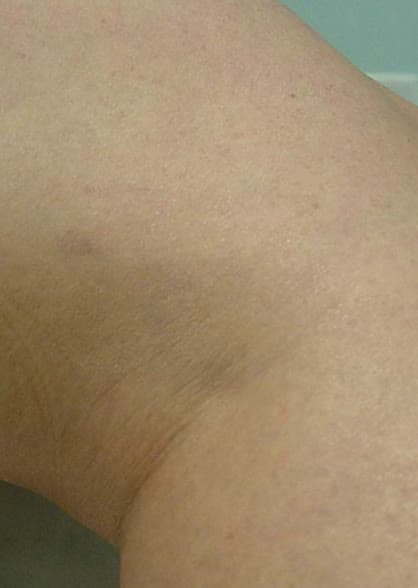 Clear skin after spider vein removal at Neoderma Anaheim