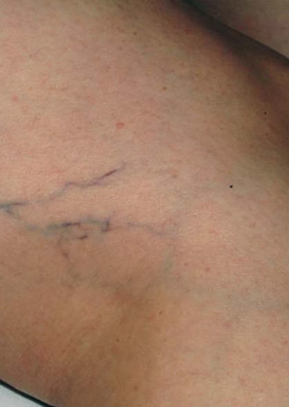 Before vein removal at Neoderma Anaheim: prominent blue spider veins behind the knee