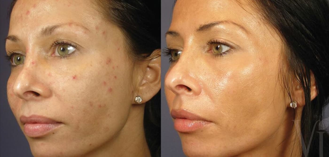 Before and after a Vi Peel at Neoderma Anaheim: active acne and congestion cleared to a smooth, even glow
