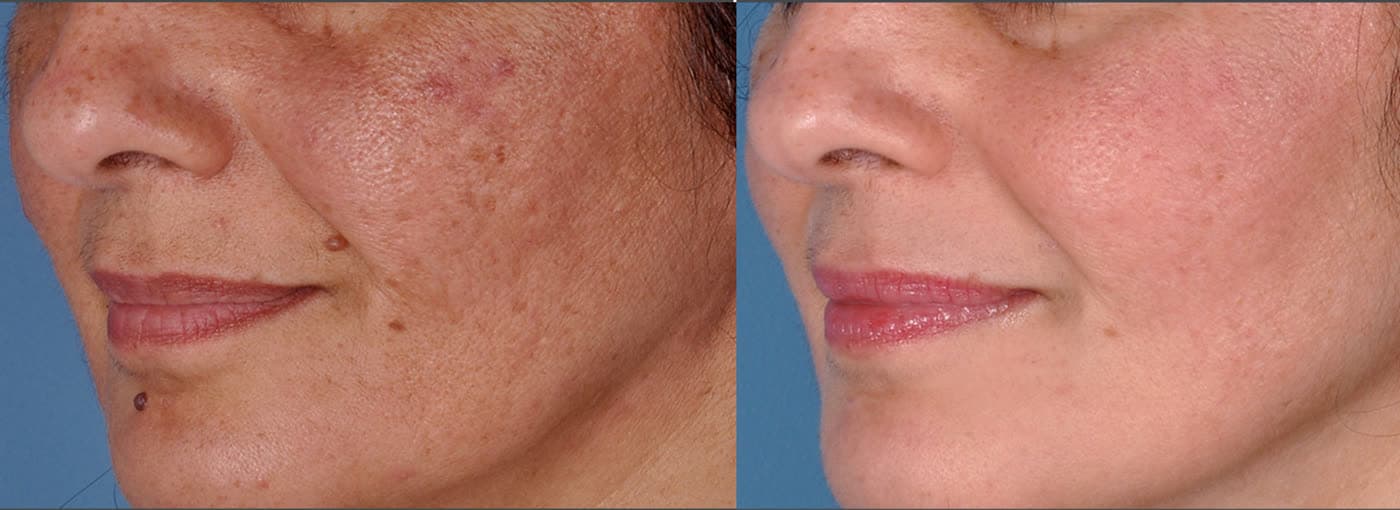 Before and after a Vi Peel at Neoderma Anaheim — summer sun spots faded to an even skin tone