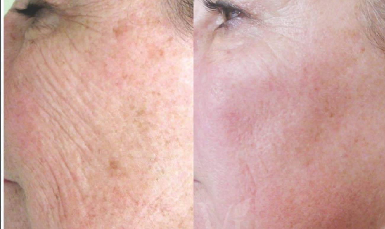Before and after a Vi Peel at Neoderma Anaheim: fine lines, texture, and pigment on the cheek softened