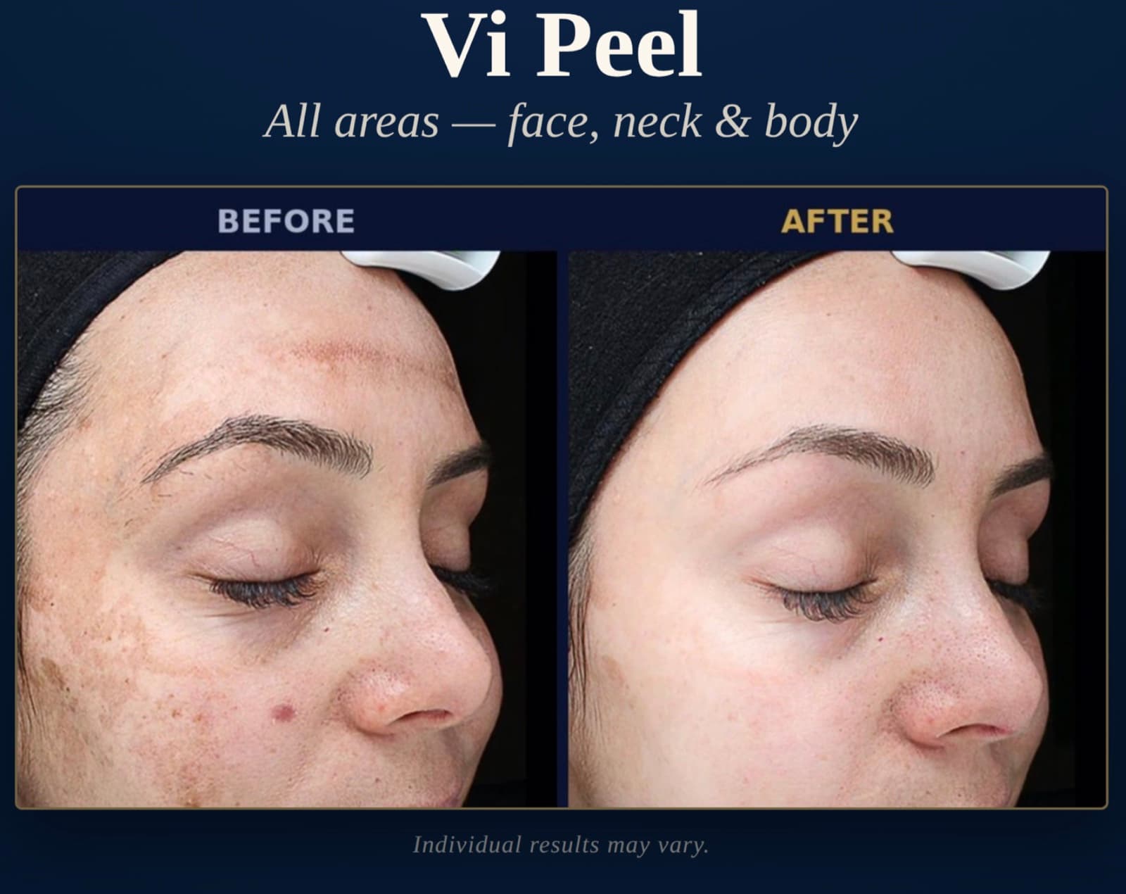 Vi Peel before and after at Neoderma Anaheim: melasma and sun spots across the face visibly cleared for brighter, more even skin